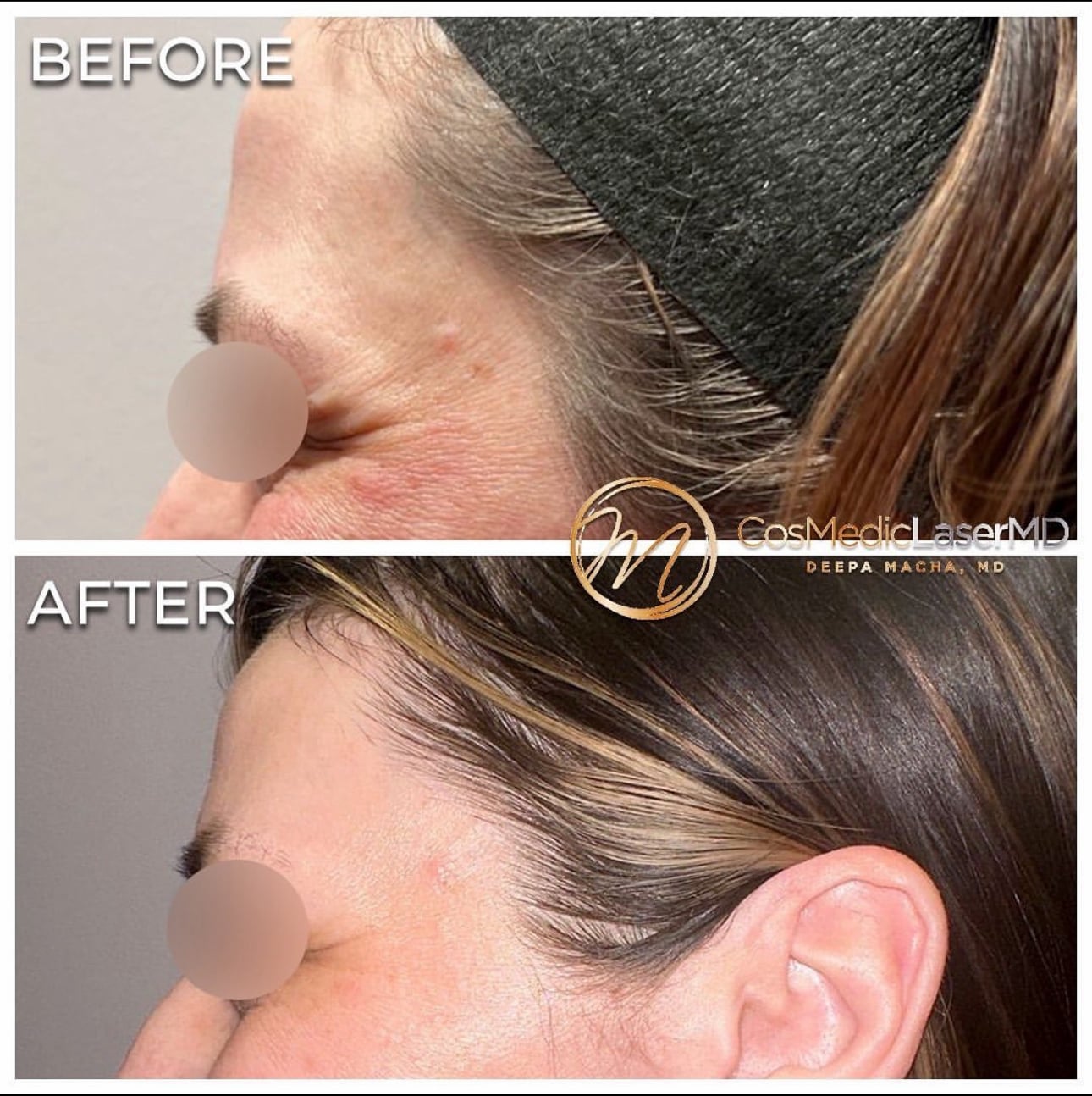 masseter botox near me