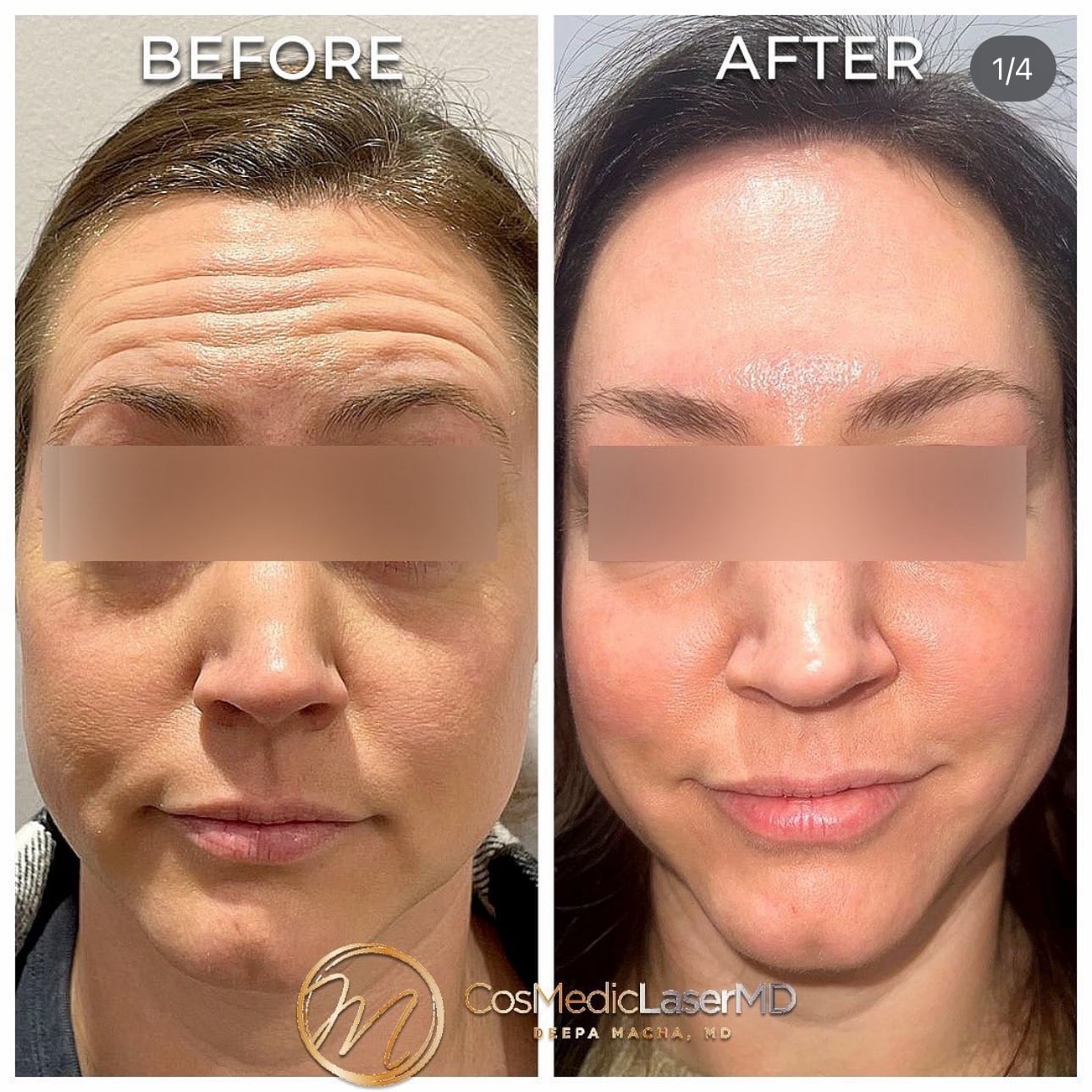 tmj botox near me