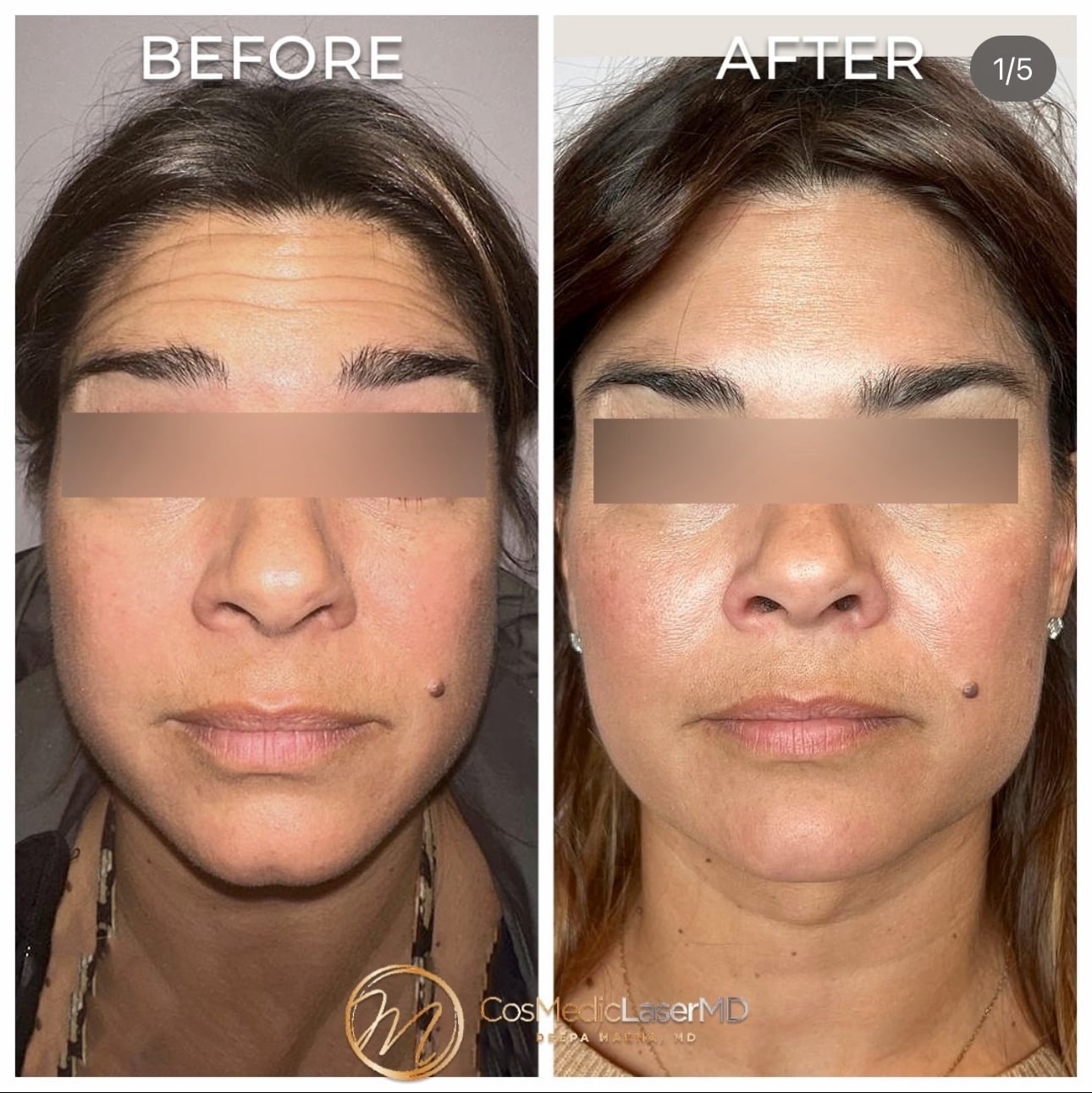 jaw botox near me ann arbor